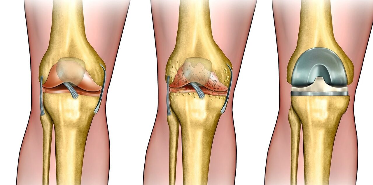 What is arthrosis