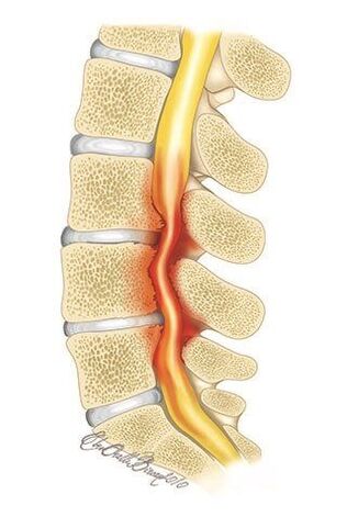 In osteochondrosis of the chest, compression of the spinal canal occurs