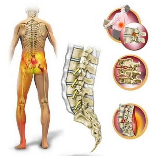 Osteochondrosis of the lumbar spine causing back pain