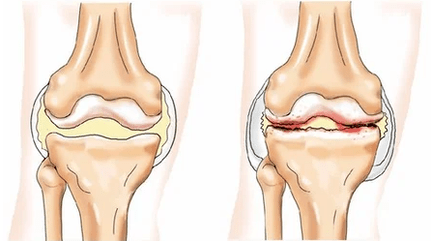 Chondromatosis