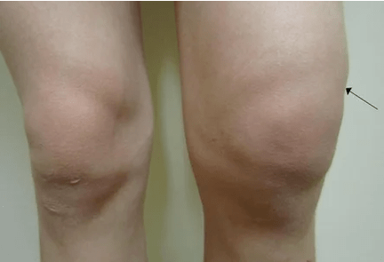 Knee hemarthrosis