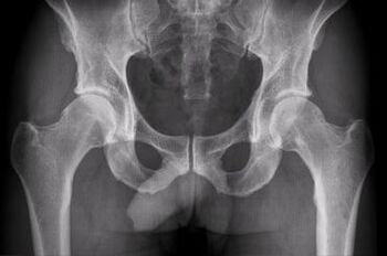 Diagnostic options for hip arthrosis joint