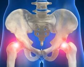 The causes of hip arthrosis joint