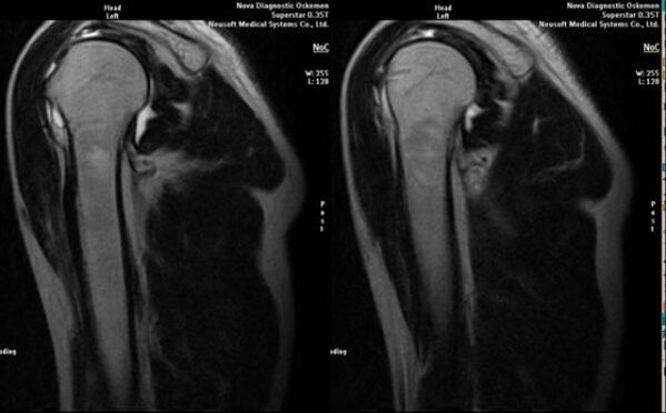 x-ray to diagnose shoulder arthrosis
