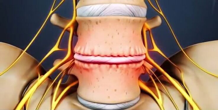 lesions of the spine due to osteochondrosis